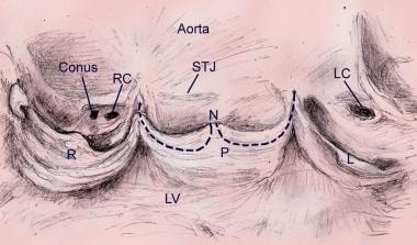 This image shows an opened aortic valve demonstrat