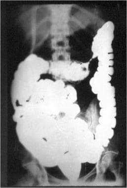 Haustra of descending (left) colon 