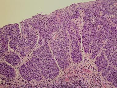 squamous cell carcinoma in situ histology