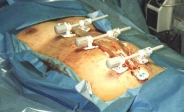 SciELO - Brasil - Temporary abdominal closure with zipper-mesh device for  management of intra-abdominal sepsis Temporary abdominal closure with zipper-mesh  device for management of intra-abdominal sepsis