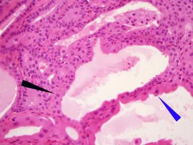intraductal papilloma medscape durere la îndepărtarea verucilor genitale