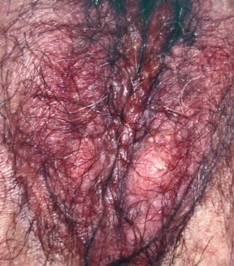 Benign vulvar lesions. Epidermal inclusion cyst lo