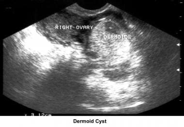 Infertility. Dermoid cyst. Image courtesy of Jairo
