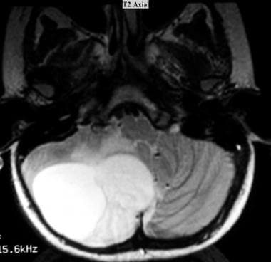 Juvenile pilocytic astrocytoma (JPA). Axial T2-wei