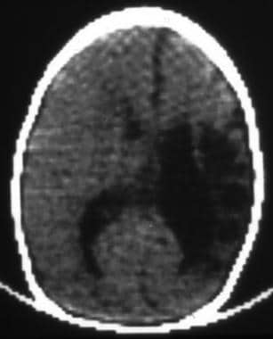 Computed tomography scan of an 8-week-old baby aft