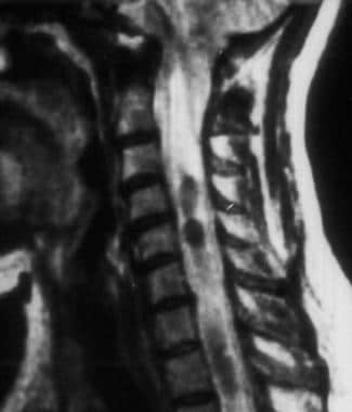 Corresponding T2-weighted cervical MRI scan of a p