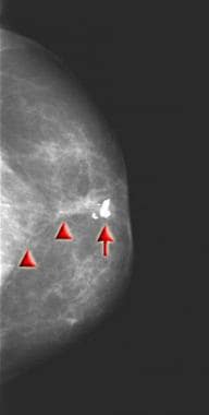 Craniocaudal mammogram obtained 2 years after lump