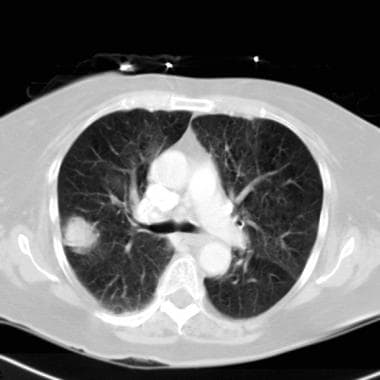 Lung cancer, small cell. Axial CT scan though the 
