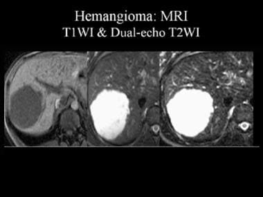 Magnetic resonance image (MRI) of a hemangioma. Th