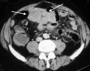 Small-bowel gastrointestinal stromal tumor with a 