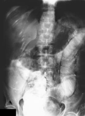 Pneumoperitoneum. Plain abdominal radiograph in a 