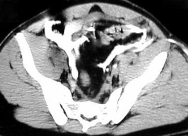 Computed tomography (CT) cystogram demonstrating a