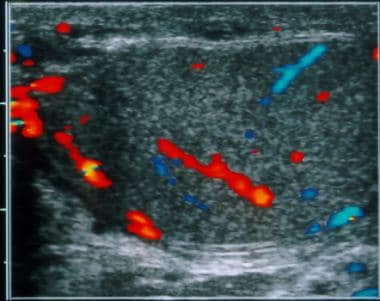 Normal testis. Transverse color Doppler image demo