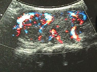 Color-flow ultrasonogram in a patient with Graves 