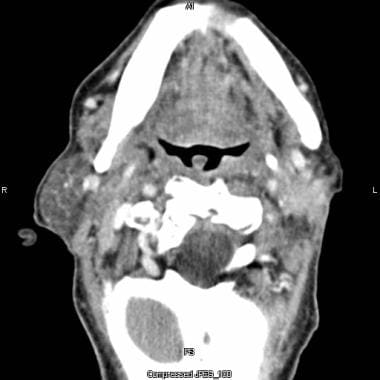 Parotid, malignant tumors. Axial contrast-enhanced