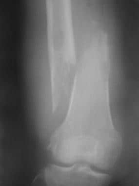 Pathologic fracture. Radiograph shows a displaced 