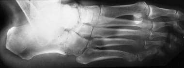 Neuropathic arthropathy (Charcot joint). Oblique v