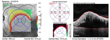 Optical coherence tomography (OCT) of a patient wi