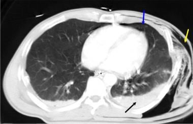 Axial computed tomography image of the chest in a 