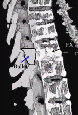 Thoracic spine trauma. Shaded-surface 3-dimensiona