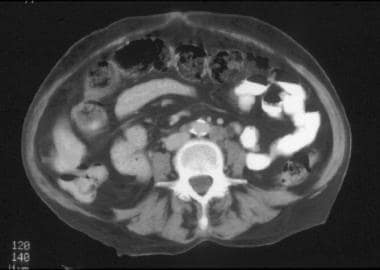 CT of a patient with stage IVB cervical carcinoma.