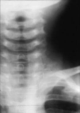 Anteroposterior radiograph in a patient with croup