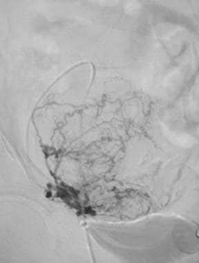 Selective angiogram of the right uterine artery pr