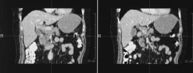 Coronal reconstructions of CT images in the same p