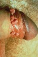 Nonmalignant Dermatologic Diseases of the Male Genitalia