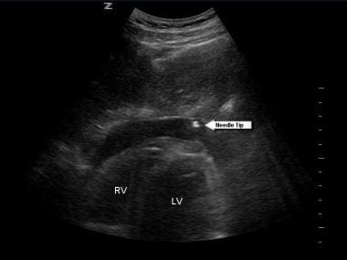 Pericardiocentesis. Subxiphoid view of the heart d