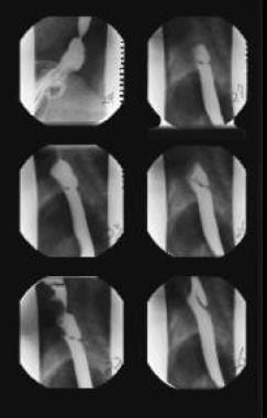 Images obtained during barium swallow videofluoros