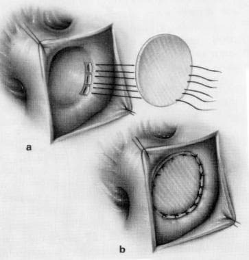 Patent Ductus Arteriosus Surgery. Patch closure of