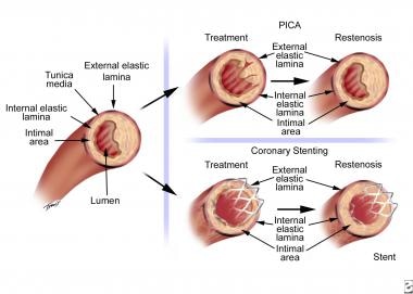 Mechanism of restenosis following percutaneous tra