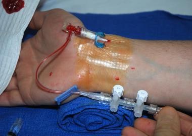 Radial artery cannulation (modified Seldinger). In