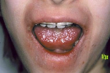 Allergic contact reaction due to nickel in a denta