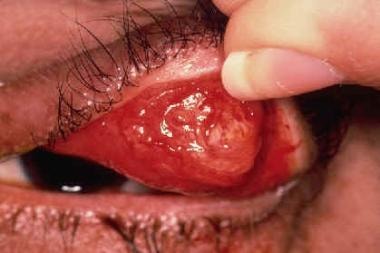 Sebaceous carcinoma as viewed from the conjunctiva