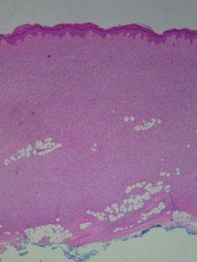 Dermatofibrosarcoma protuberans (DFSP) tumor cells