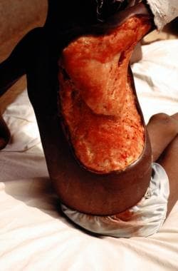An edematous Buruli ulcer in a 9-year-old Togolese