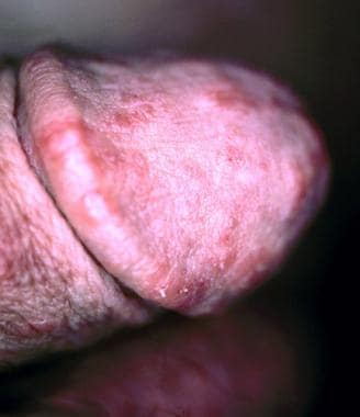 Scabies on penis. Courtesy of Hon Pak, MD. 