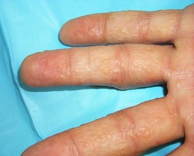 dyshidrotic eczema dyshidrotic dermatitis