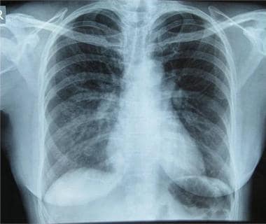 High-altitude pulmonary edema (HAPE). Initial ches