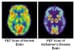 Alzheimer Disease