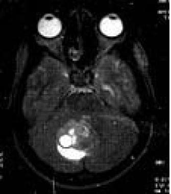 Cerebellar medulloblastoma. This MRI (axial view, 