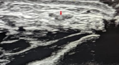 Needle within radial artery in short-axis view. Re