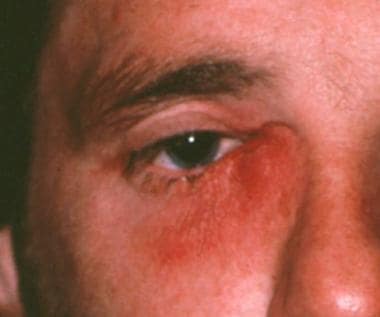 lacrimal punctum swollen