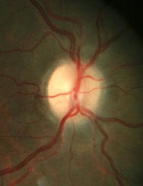 Right optic disc with postpapilledema optic atroph