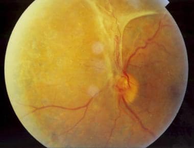 Patient with a central retinal vein occlusion comp
