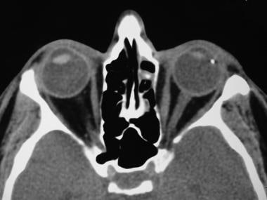 Metal intraocular foreign body located in the left