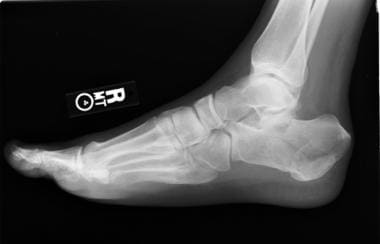 Calcaneus fractures. Avulsion-type fracture of cal