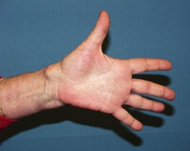 Ganglion Cyst Pressure Motor Branch of the Median Nerve